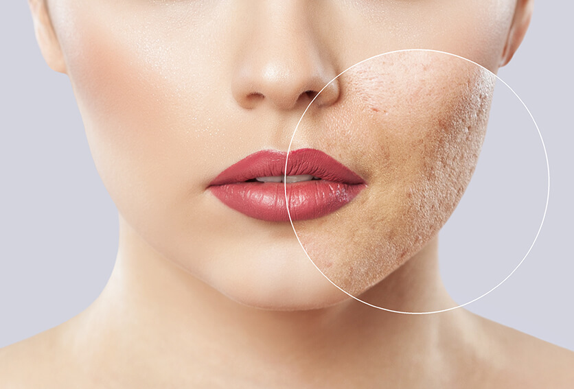 Acne treatment singapore