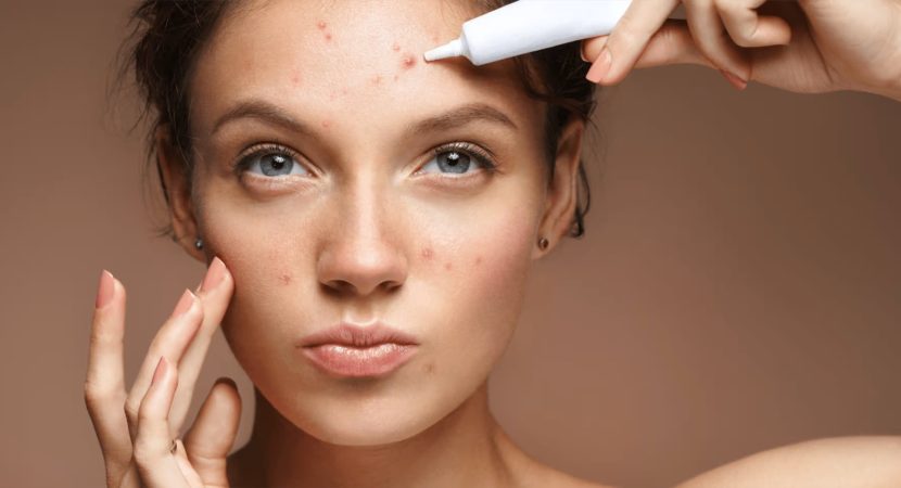 The Top 10 Methods for Preventing Acne