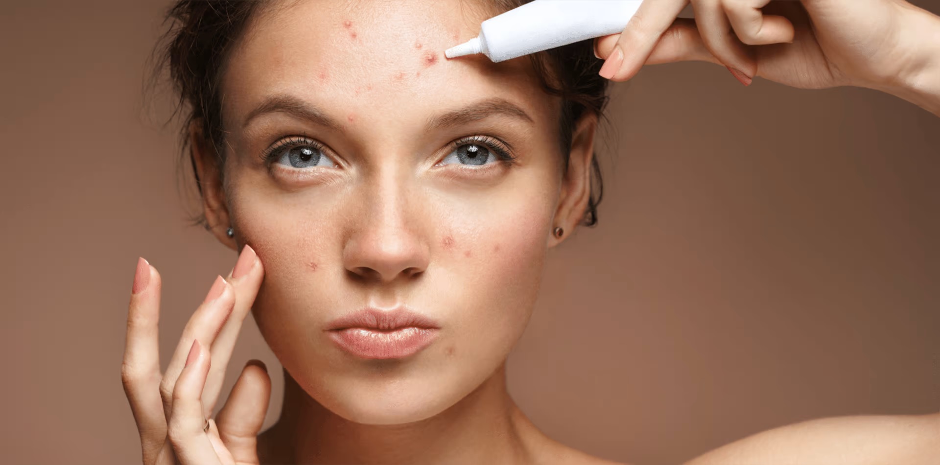 The Top 10 Methods for Preventing Acne